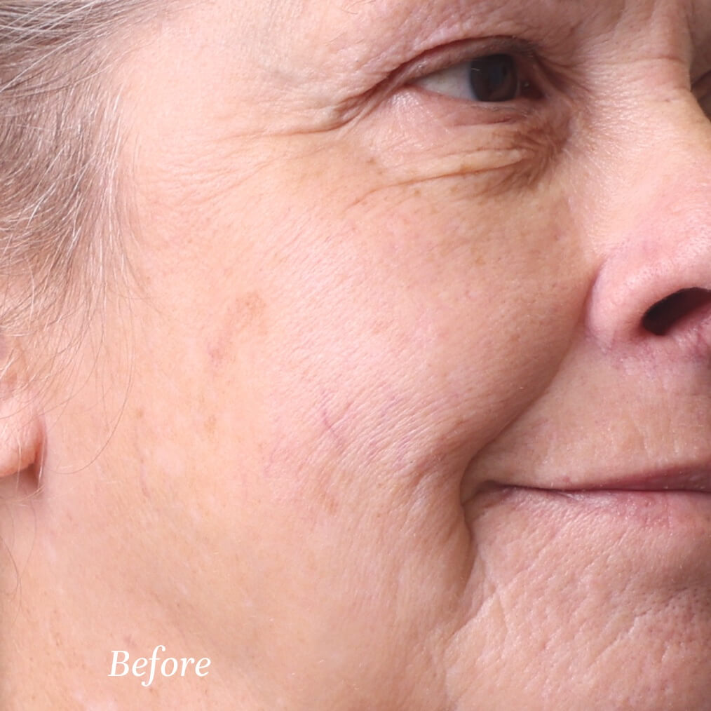 Close-up of an elderly person's face with visible wrinkles, labeled 'Before'.
