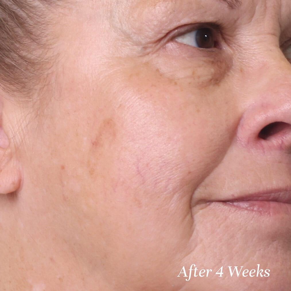 Close-up of a person's face showing skin texture improvement after 4 weeks.
