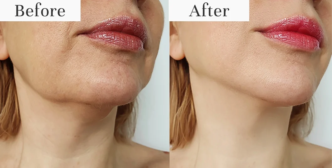 <p><strong>4. Watch Your Deepest Wrinkles Visibly Fade Away</strong></p>