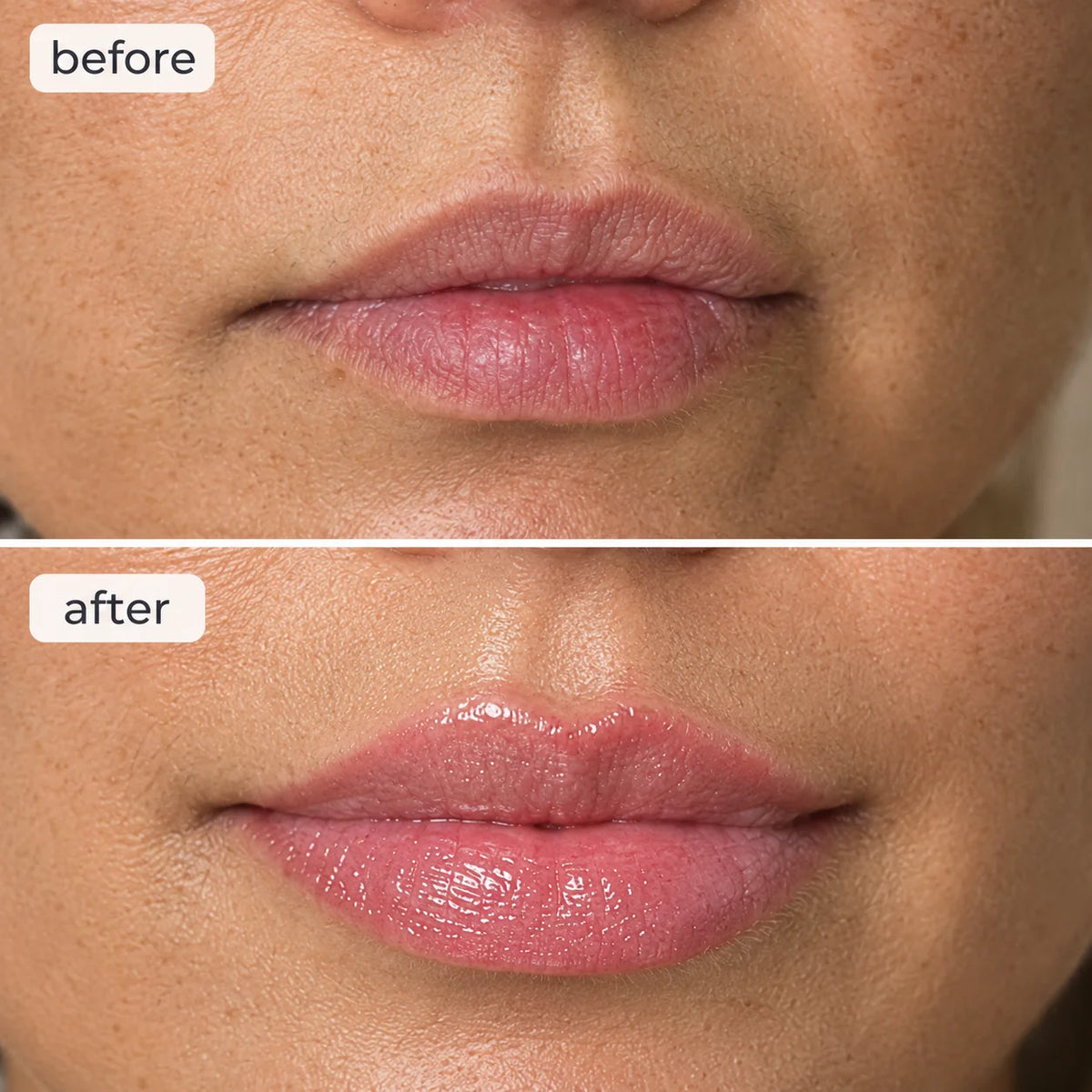 Thinking About Lip Fillers? Here's Why 50,000+ Women Canceled Their Appointments