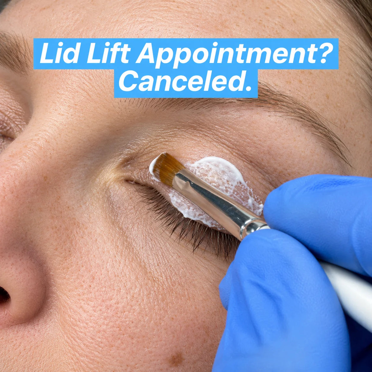<i>Considering An Upper Bleph or Lid Lift? Here's Why 50,000+ Women Canceled Their Appointments</i>