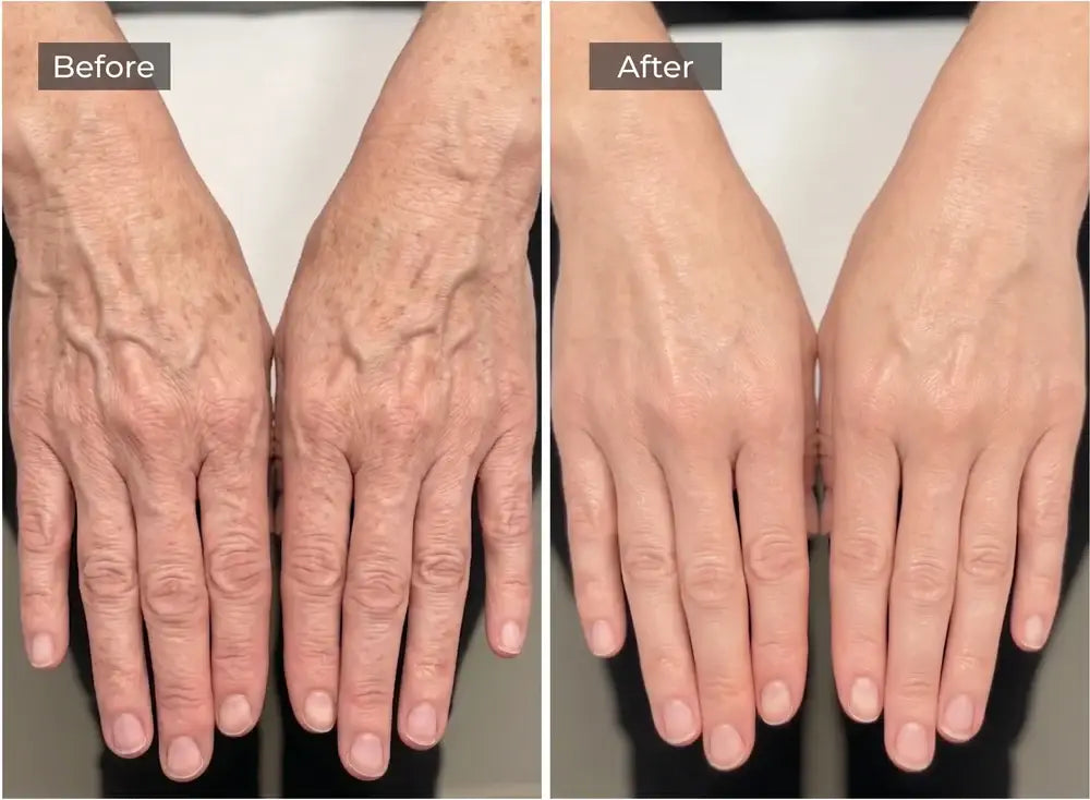 Lifts Sagging Skin in 30 Minutes