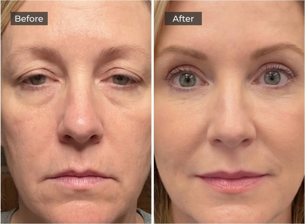 Lifts Hooded Lids<br>In 60 Seconds
